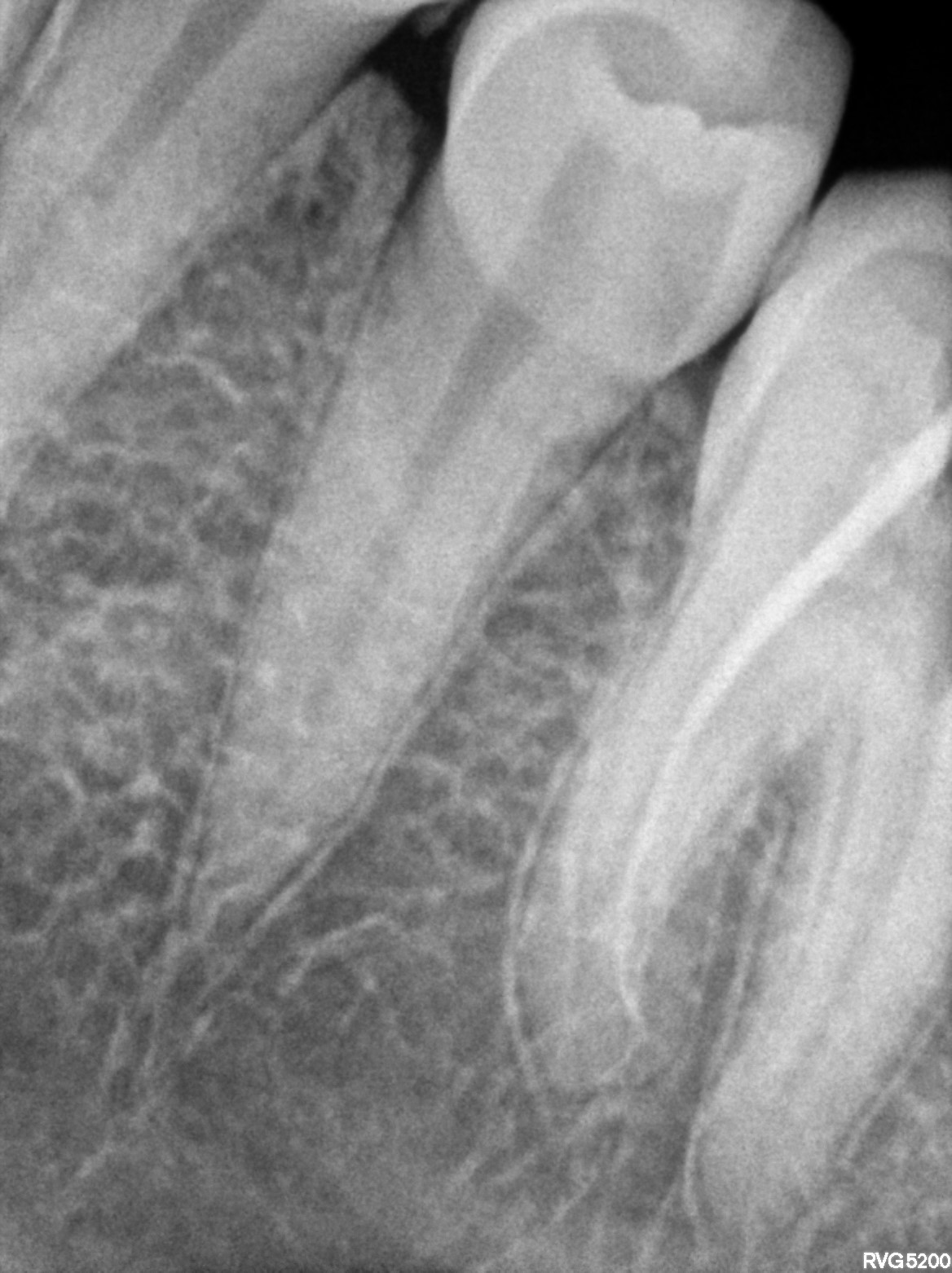 Dental X-ray